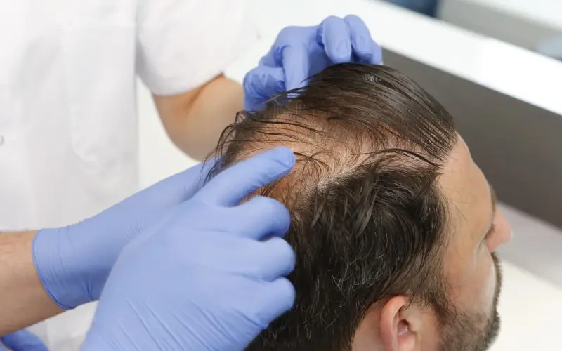 Gloved hands parting a patient's hair to assess the donor area