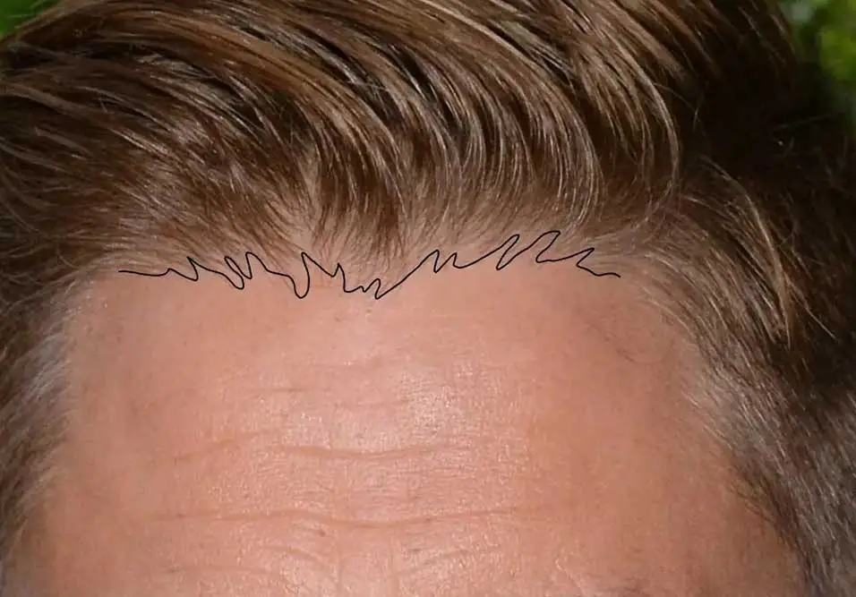 Comparison of a natural hairline and a transplanted hairline