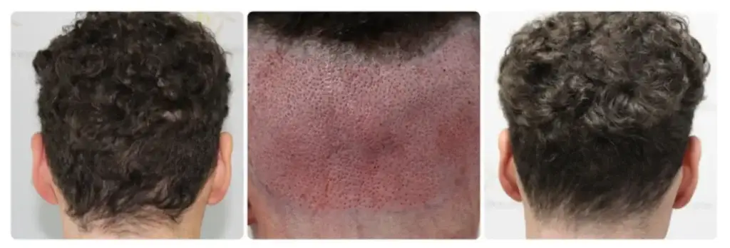 Donor area at the back of the scalp healing after FUE graft extraction