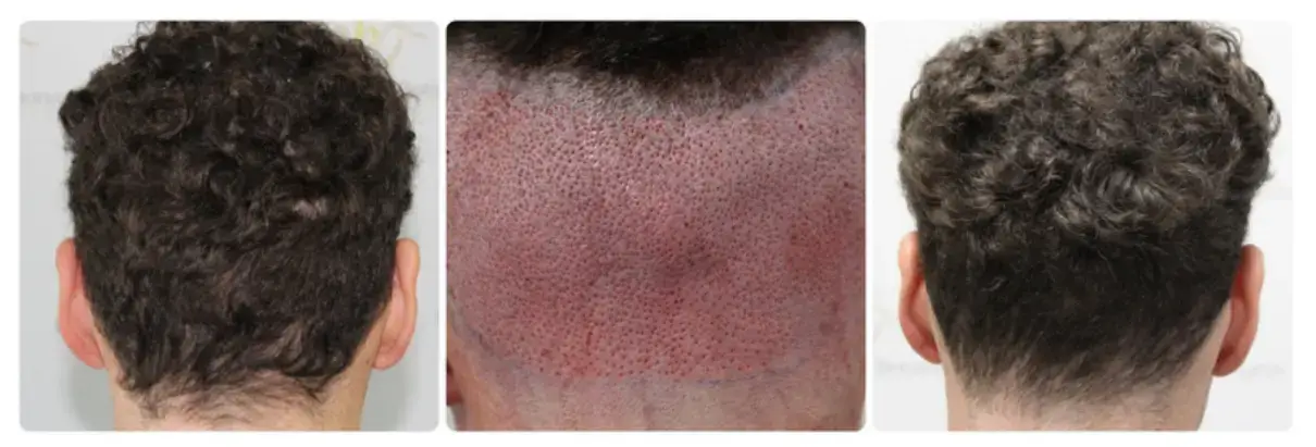 Donor area at the back of the scalp healing after FUE graft extraction