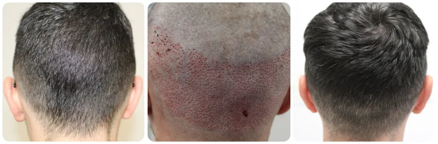Donor area at the back of the scalp healing after FUE graft extraction