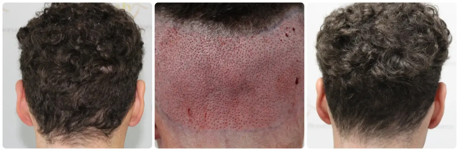 Donor area at the back of the scalp healing after FUE graft extraction