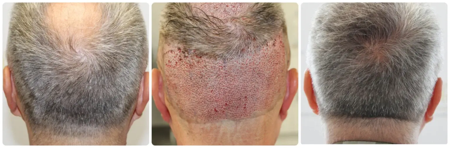 Donor area at the back of the scalp healing after FUE graft extraction