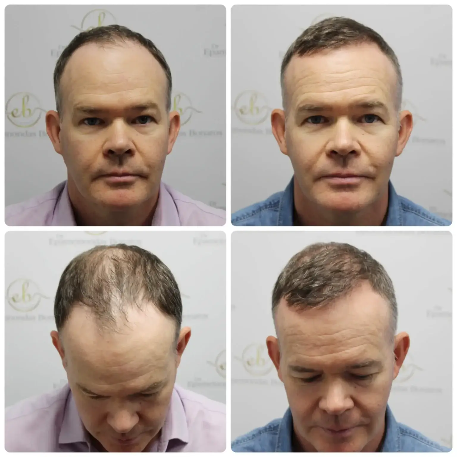 Before and after FUE hair transplant result performed by Dr Bonaros in Glasgow
