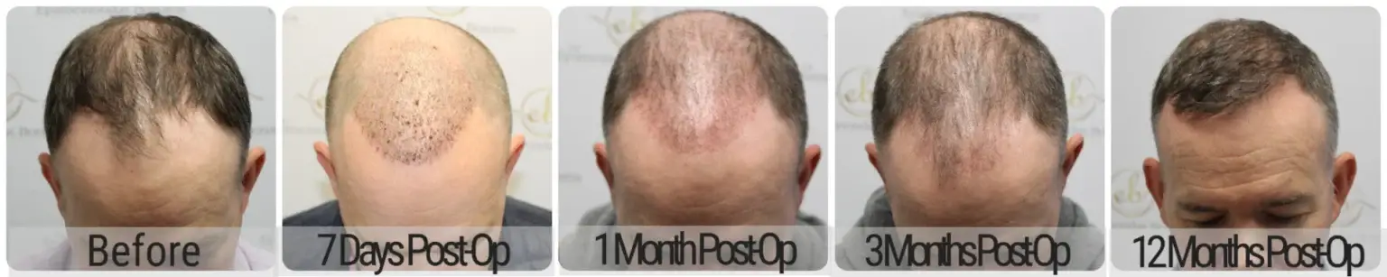 Before and after FUE hair transplant result performed by Dr Bonaros in Glasgow
