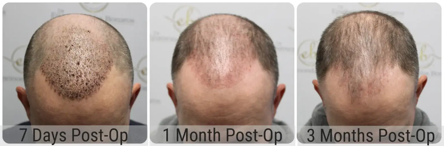 Before and after FUE hair transplant result performed by Dr Bonaros in Glasgow