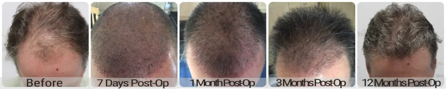Before and after FUE hair transplant result performed by Dr Bonaros in Glasgow