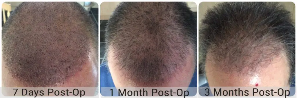 Before and after FUE hair transplant result performed by Dr Bonaros in Glasgow