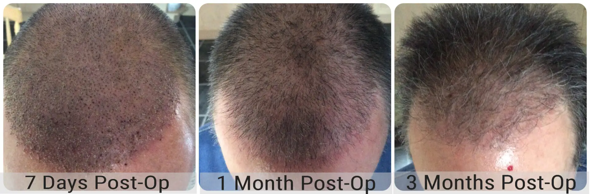 Before and after FUE hair transplant result performed by Dr Bonaros in Glasgow
