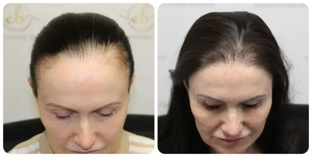 Before and after hairline transplant result restoring a receding hairline