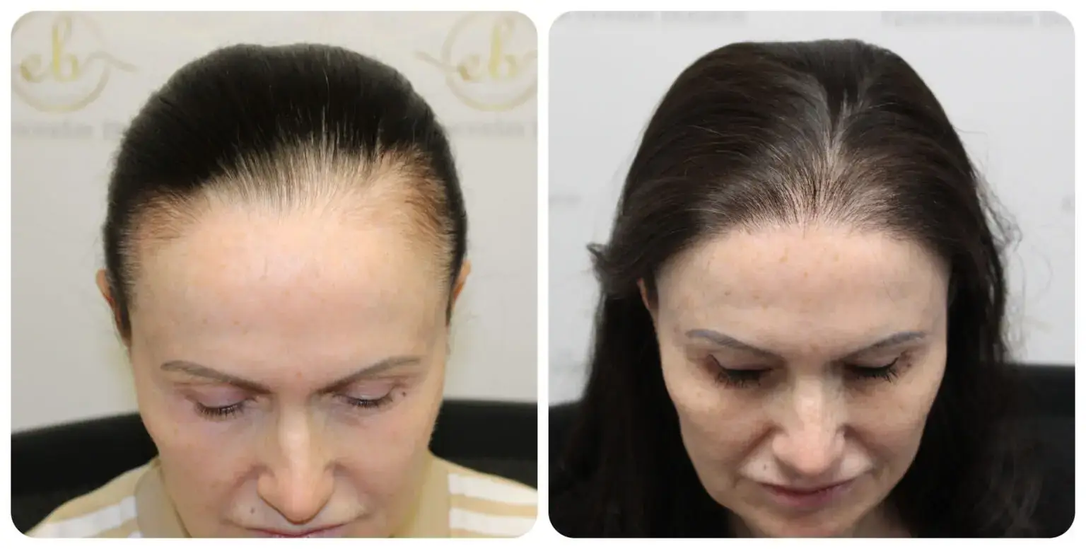 Before and after hairline transplant result restoring a receding hairline
