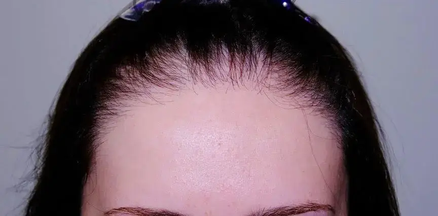 Woman's high hairline with visible frontal recession