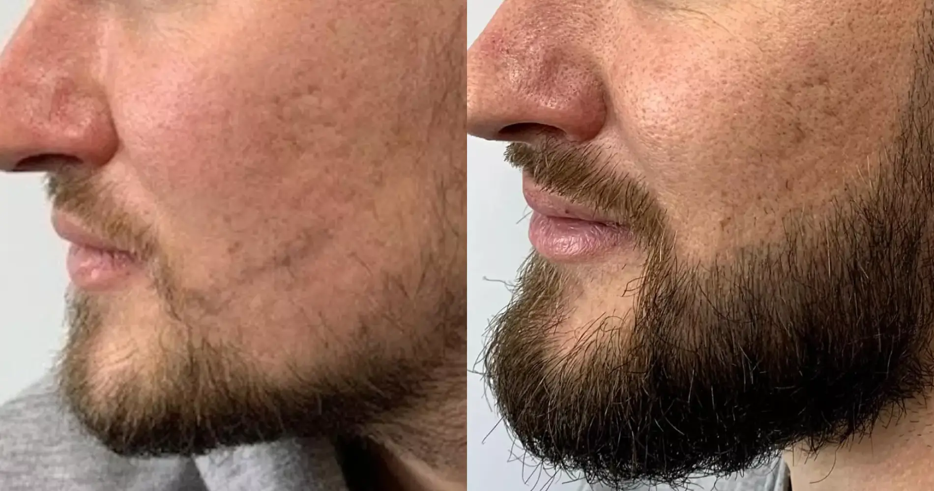 Before and after beard restoration result at the Dr Bonaros clinic in Glasgow