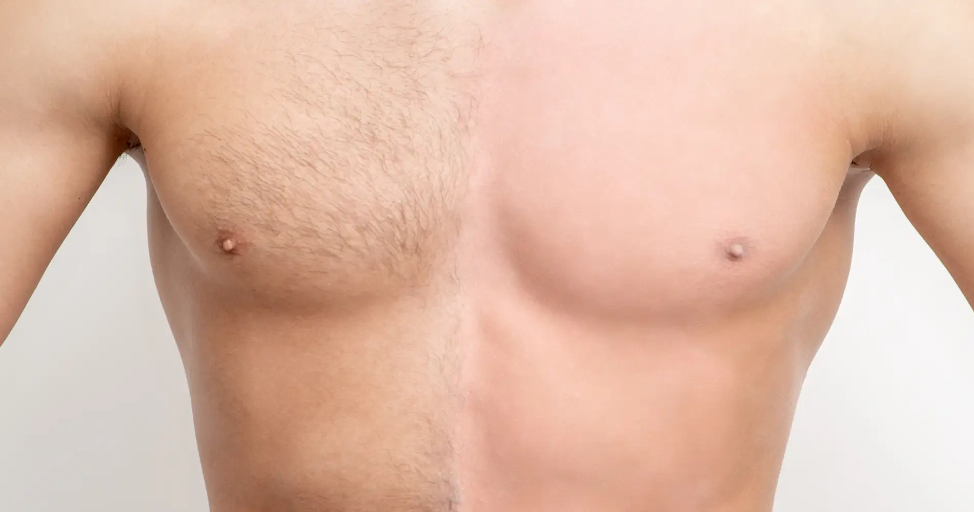 Before and after body hair transplant result at the Dr Bonaros clinic in Glasgow