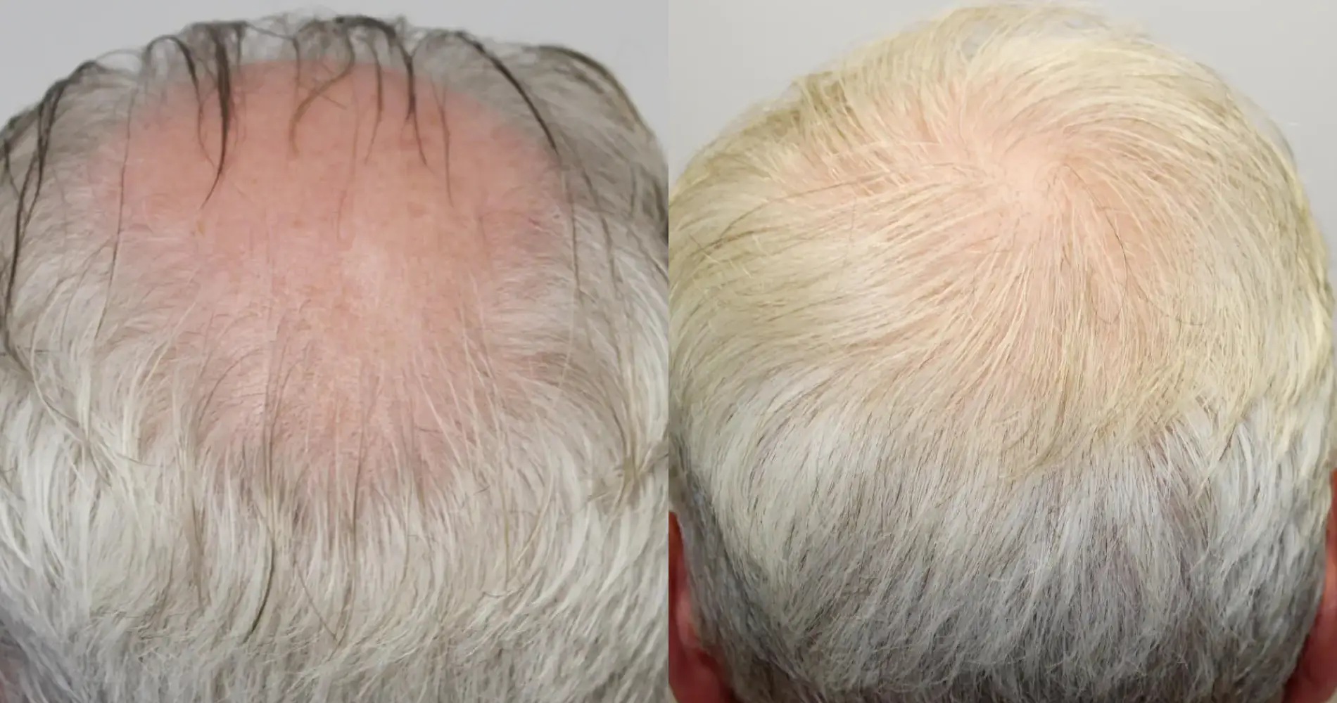 Before and after crown hair transplant result at the Dr Bonaros clinic in Glasgow