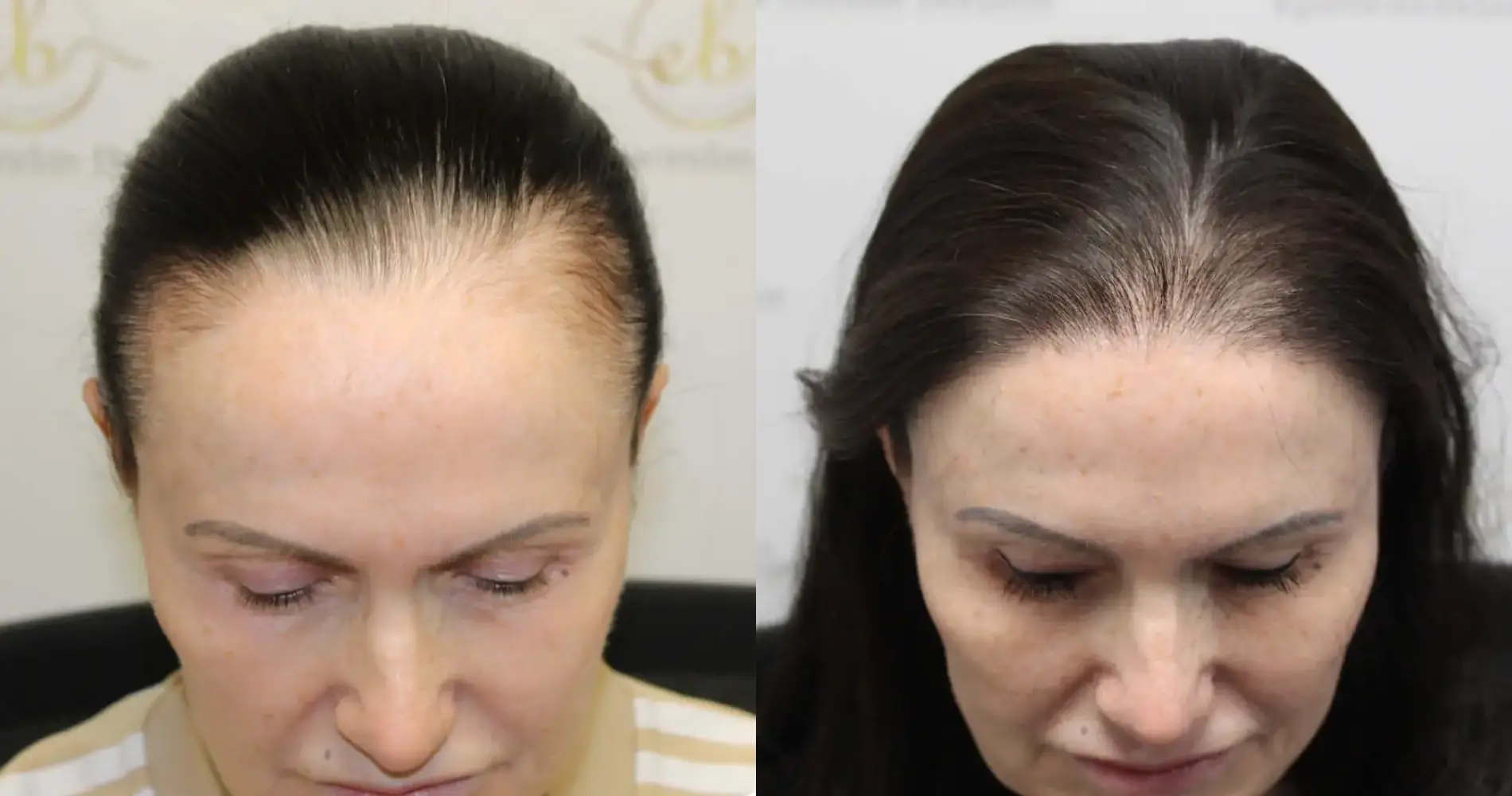 Before and after female hair transplant result at the Dr Bonaros clinic in Glasgow