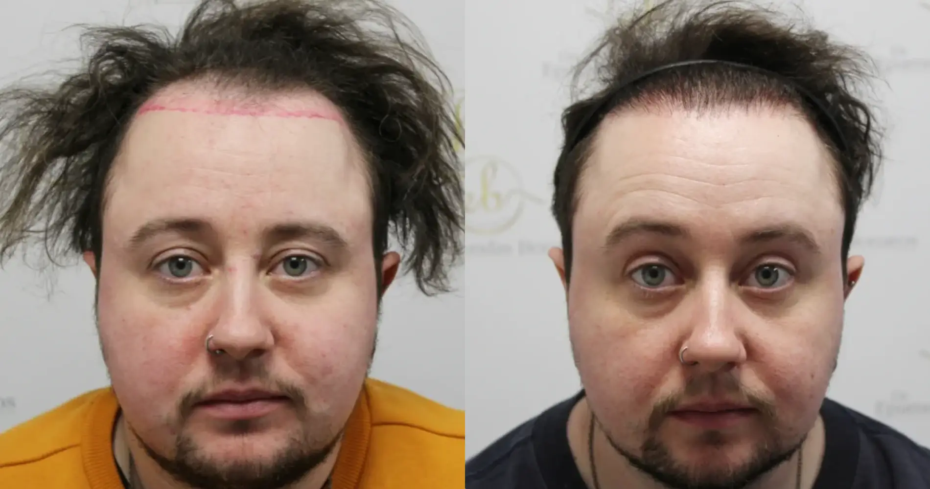 Before and after FtM hair transplant result at the Dr Bonaros clinic in Glasgow