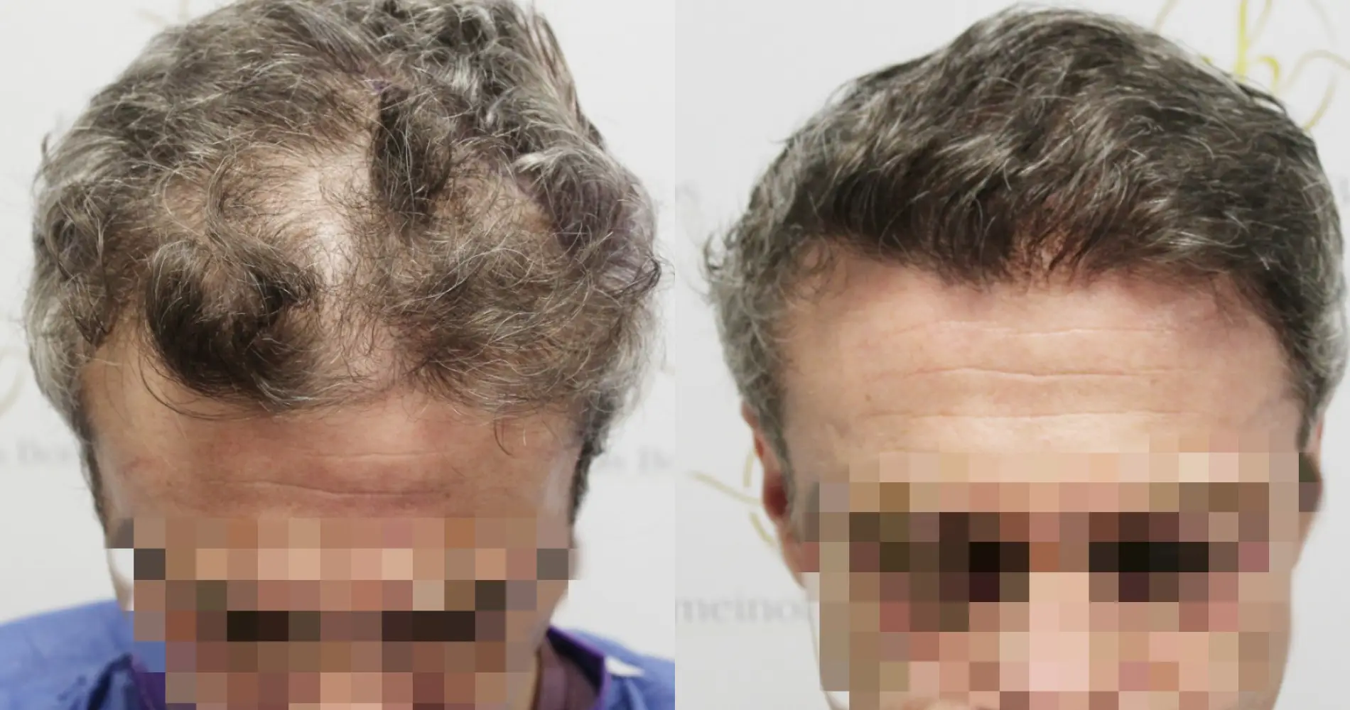 Before and after FUE hair transplant result at the Dr Bonaros clinic in Glasgow