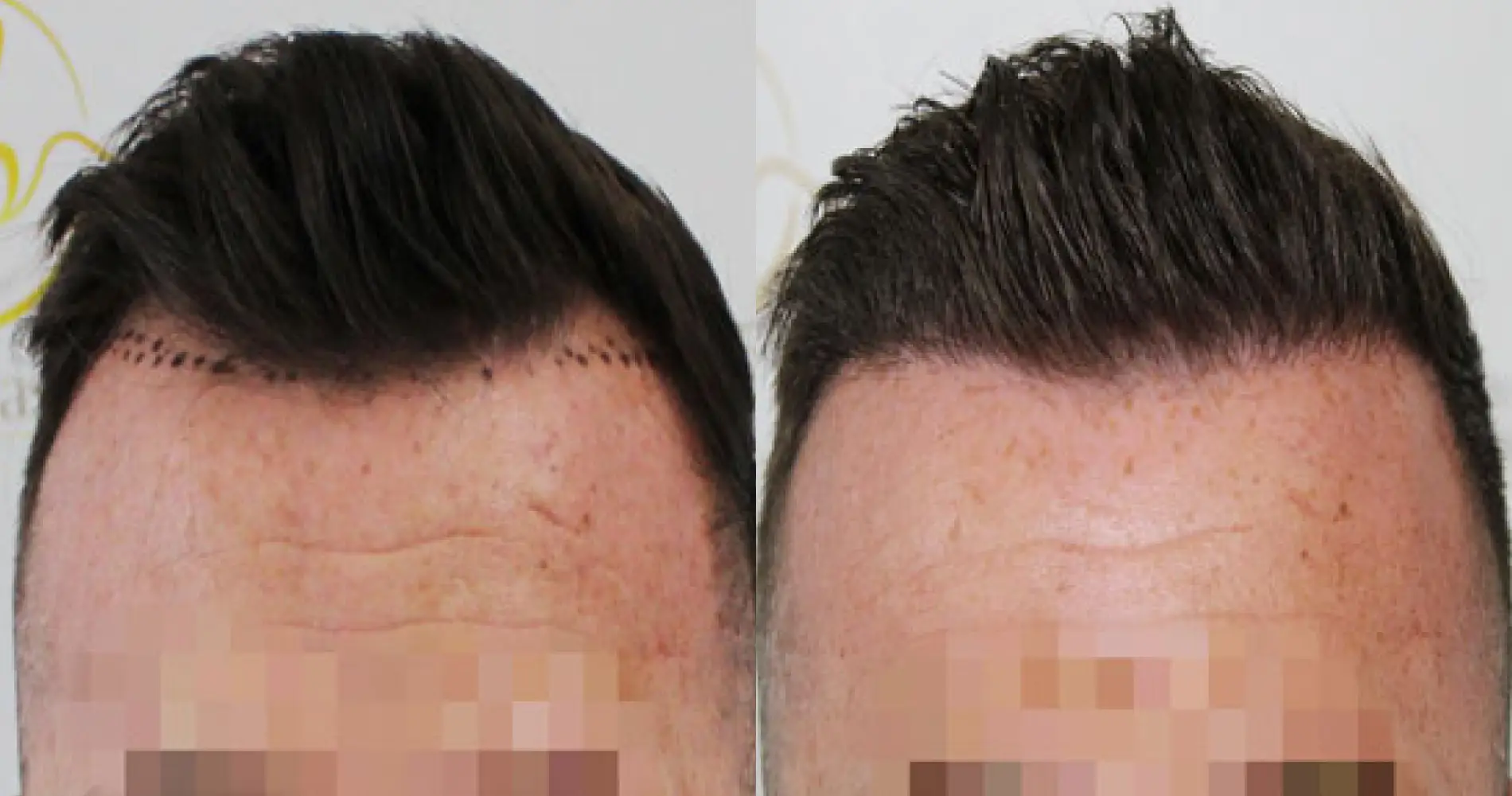 Before and after hairline transplant result at the Dr Bonaros clinic in Glasgow