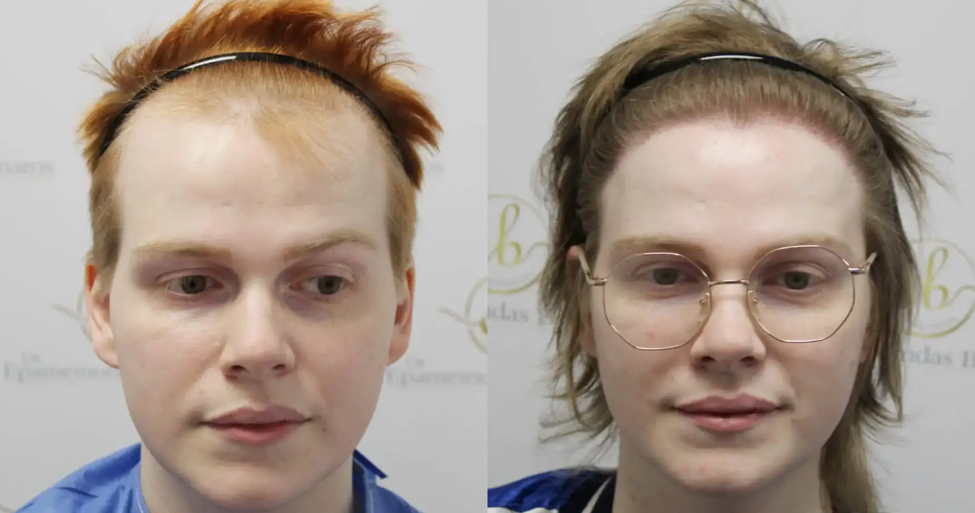 Before and after MtF hair transplant result at the Dr Bonaros clinic in Glasgow