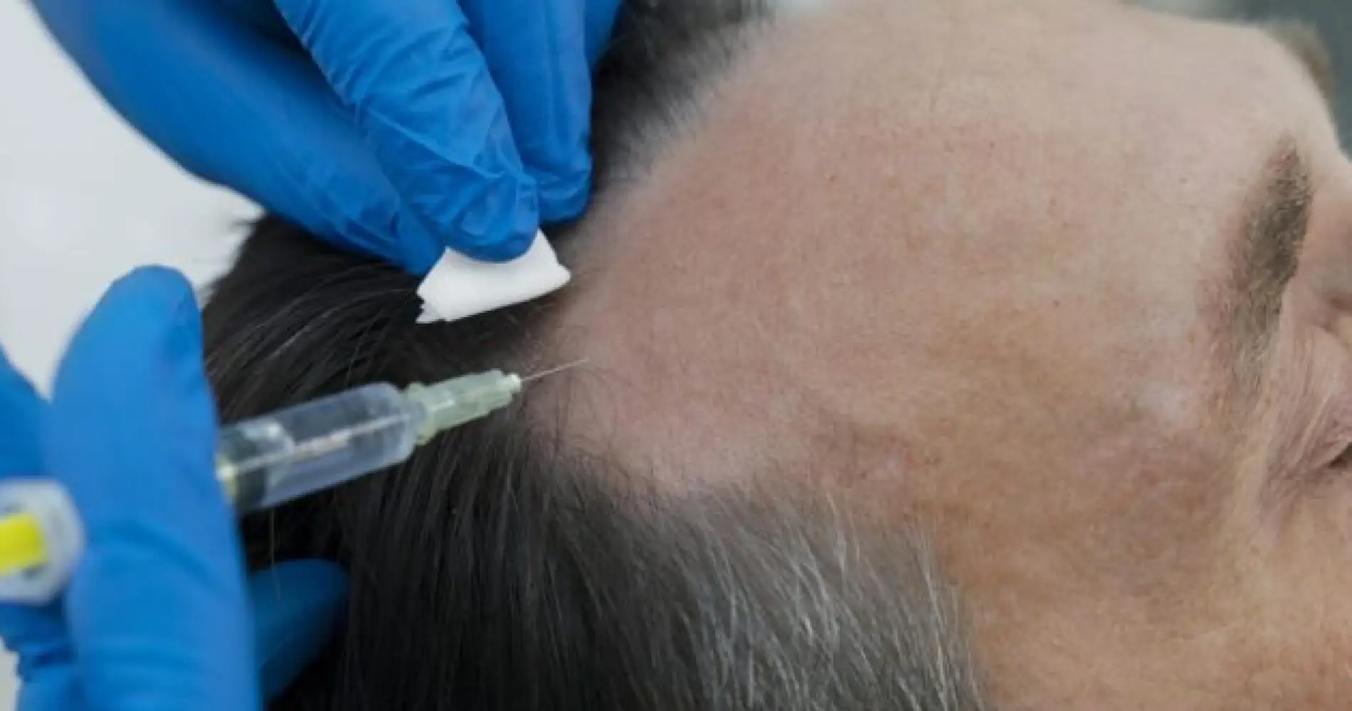 Before and after non-surgical hair treatment result at the Dr Bonaros clinic in Glasgow