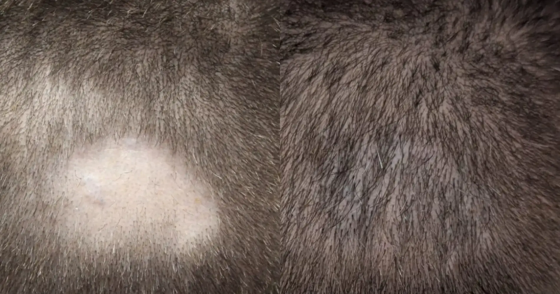 Before and after scar repair hair transplant result at the Dr Bonaros clinic in Glasgow