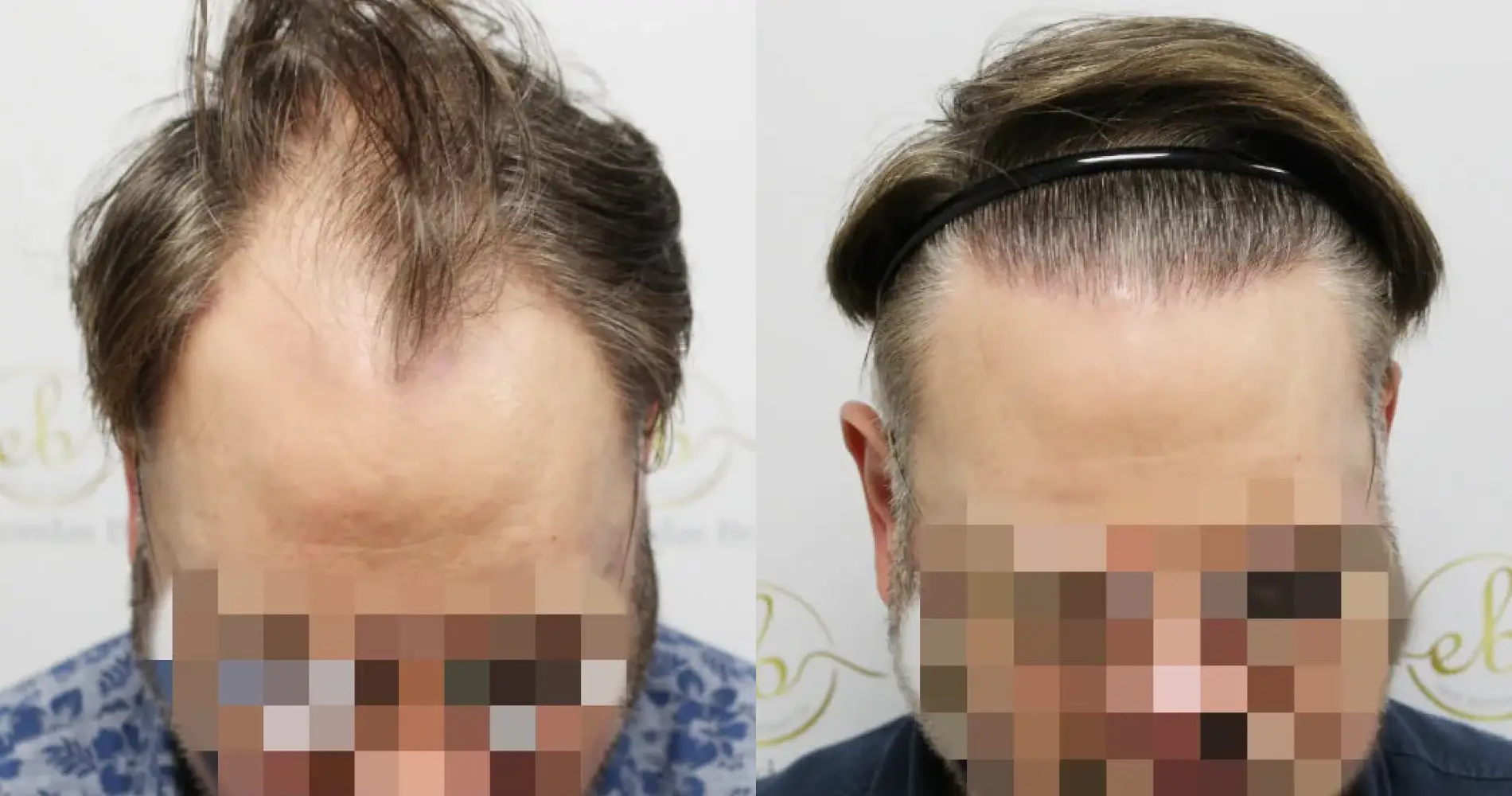 Before and after unshaven FUE hair transplant result at the Dr Bonaros clinic in Glasgow