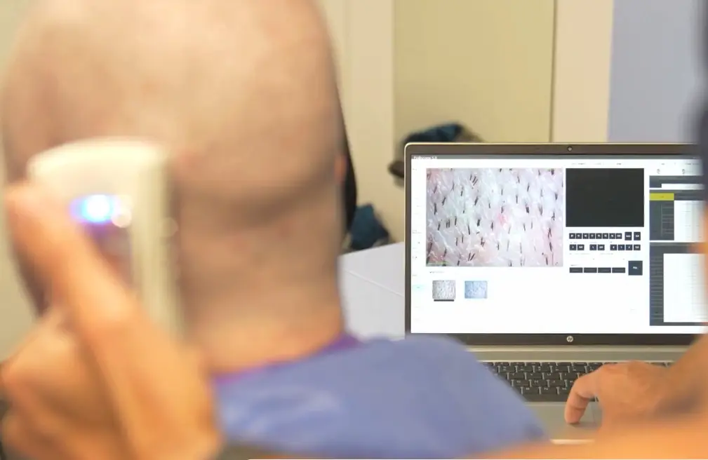 Trichoscopy assessment of a patient's scalp on a clinic monitor