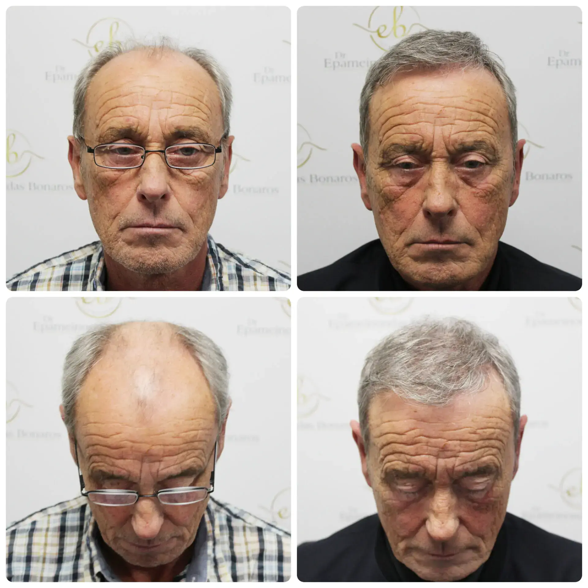 Before and after FUE hair transplant result performed by Dr Bonaros in Glasgow