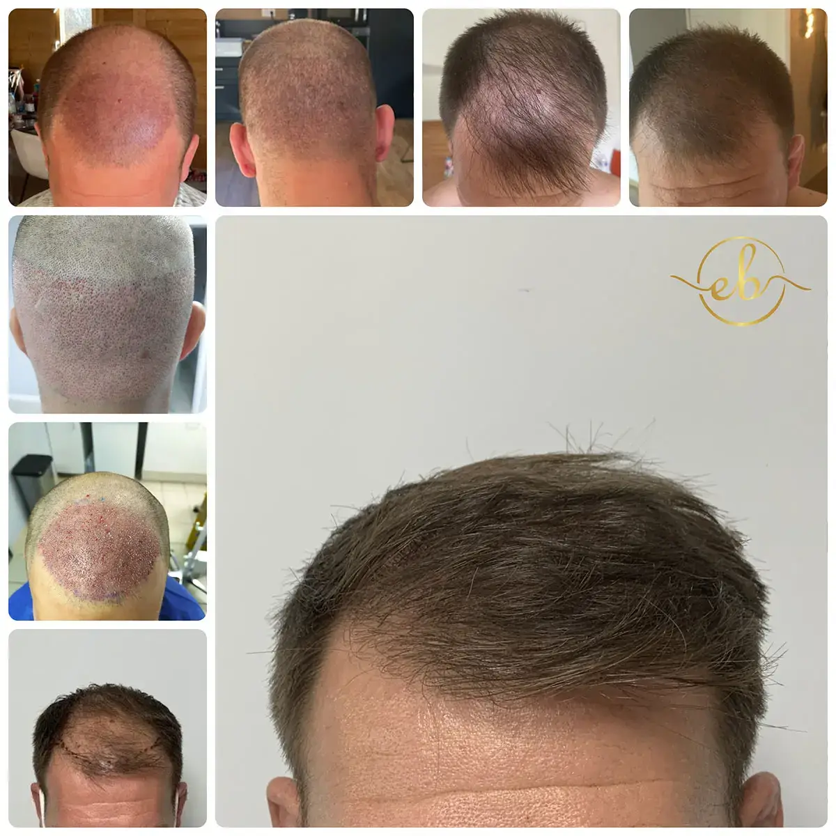 Staged photographs showing hair transplant growth from surgery through to twelve months