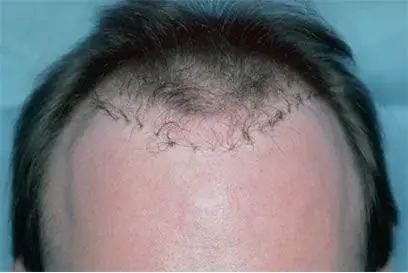 Close-up of an old-style hair plug result