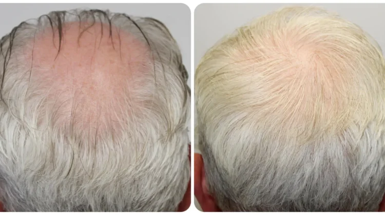 Crown hair transplant result by Dr Bonaros