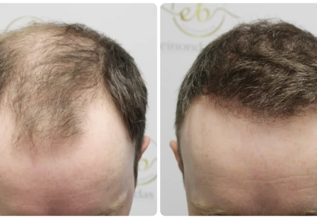 hairline transplant by Dr Bonaros in his clinic in Glasgow