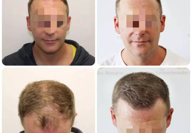 hair-transplant-before-after-fue-dr-bonaros-glasgow Hair transplant results by Dr Bonaros- Receding hairline treatment Glasgow clinic