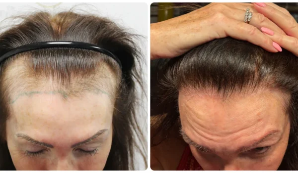 female-hairline-hair-transplant-dr-bonaros (11)